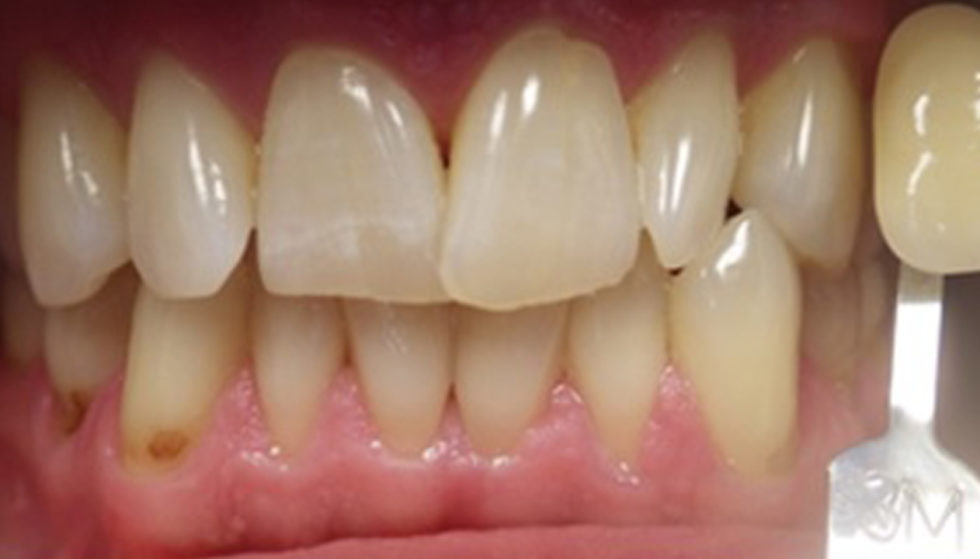 $100 Off Teeth Whitening - David J. Greer D.D.S.