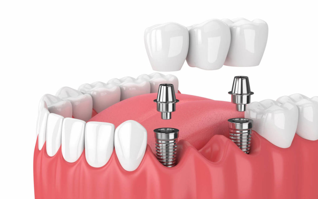 3 Common Types of Dental Implants