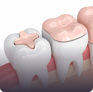 Illustration of two white molar teeth in a row, one with a pink dental filling. The teeth are shown from the side against a light background.