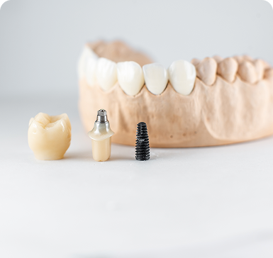 Close-up of dental implants and a tooth model. A crown, abutment with silver top, and screw-like implant part are in front of a realistic jaw model.