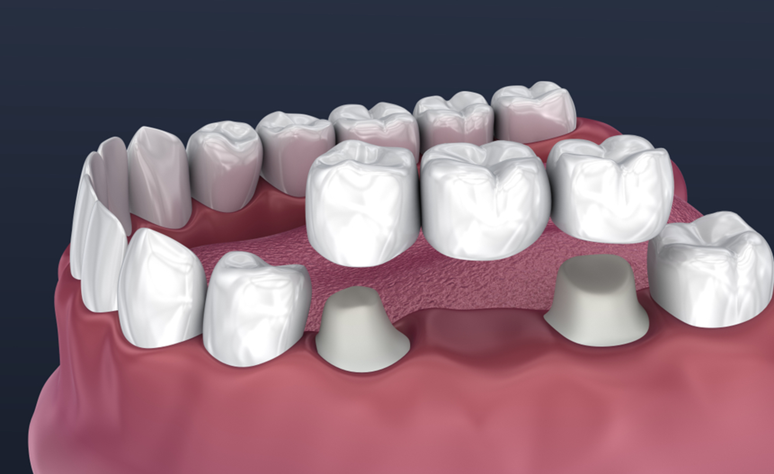 3D illustration of a dental bridge procedure. Two teeth are crowned, supporting five artificial teeth spanning a gap in the gum. Digital dentistry concept.